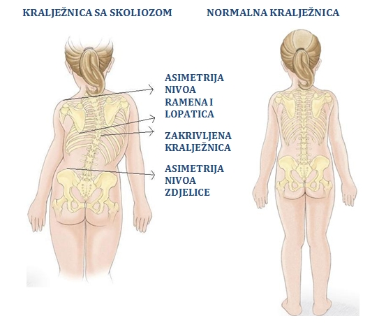 skolioza web